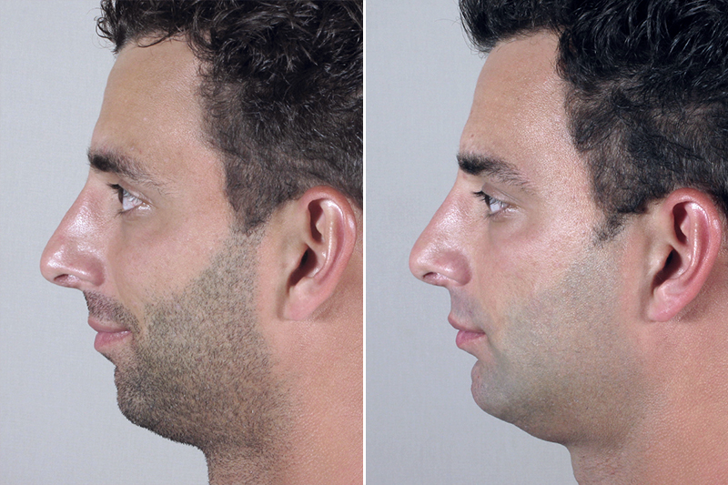 Chin Implant Male Before And After