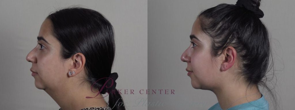 Before and after image of neck contouring patient