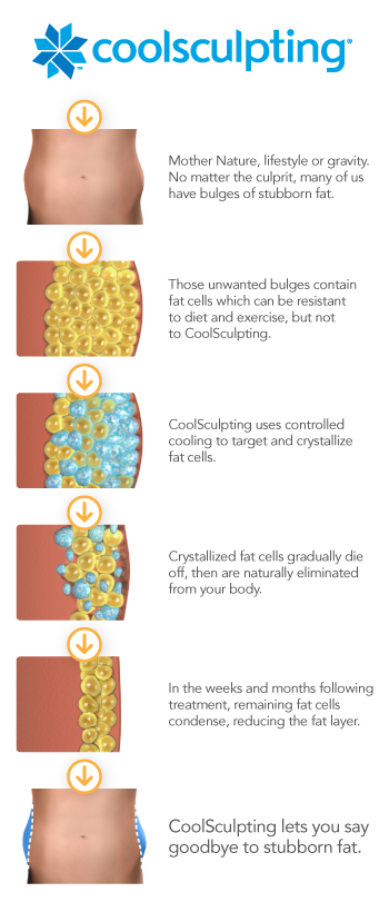 CoolSculpting® in Paramus, New Jersey