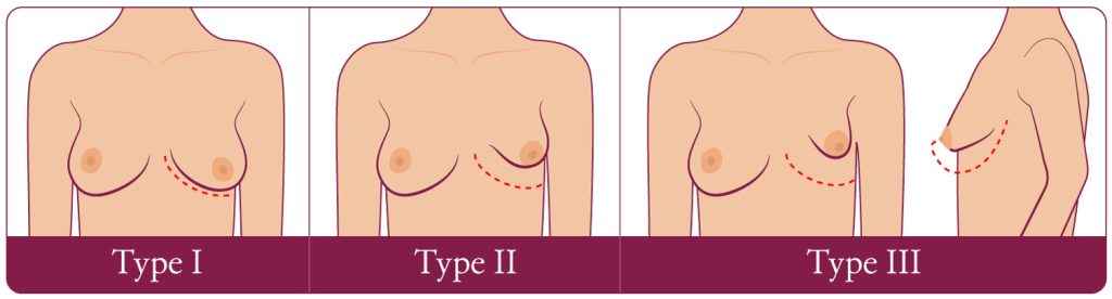 Tuberous Breast — Before & After 