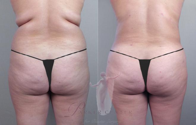 How To Get Rid Of Bra Bulge & Back Fat - VASER LIPO 360