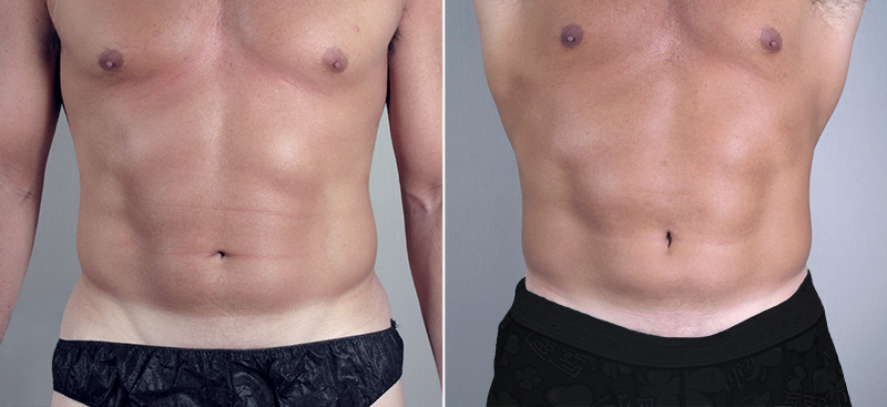 Liposuction for Men in Paramus, NJ