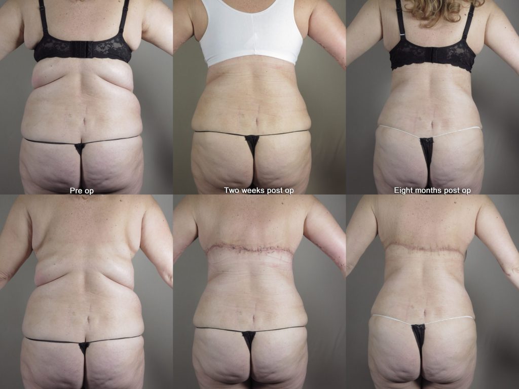 Before and after images showing bra line back lift recovery after two weeks and eight months with rapid recovery