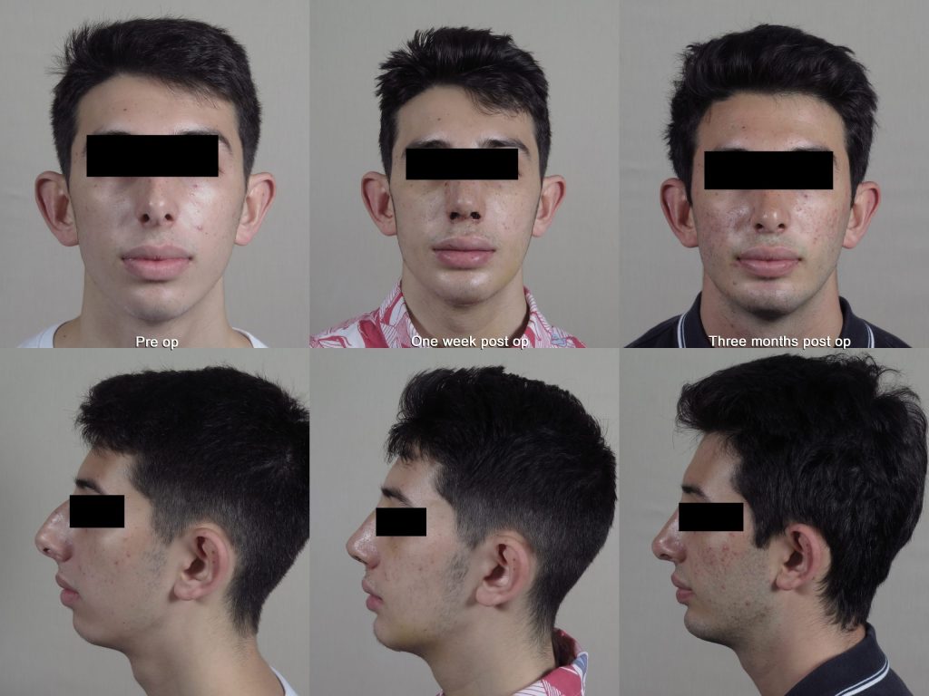 Before and after photos of recovery after chin augmentation with rapid recovery, showing one week post op and three months post op