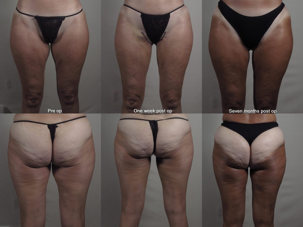 Before and after image of a thigh lift with rapid recovery showing one week and seven months post op.
