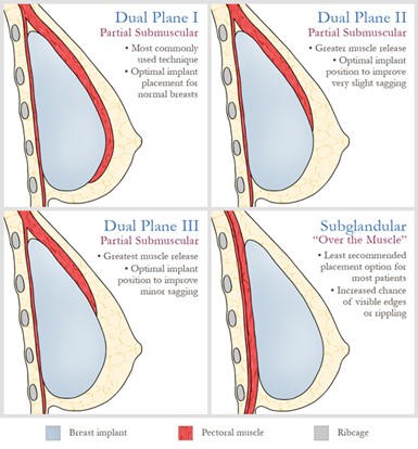 Implant placement diagram