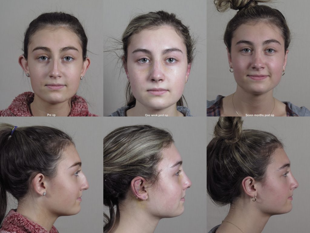 images showing the results of the rapid recovery program for rhinoplasty, with pre op, one week post op and seven months post op
