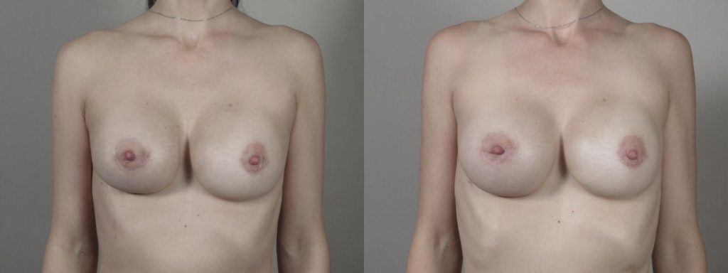 Before and after image of Aspen Ultrasound treatment for capsular contracture front view