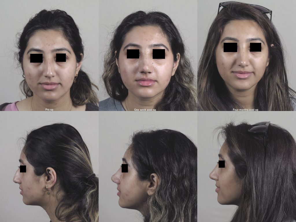 A set of images showing a rhinoplasty pre-op, one week post op, and four months post op.