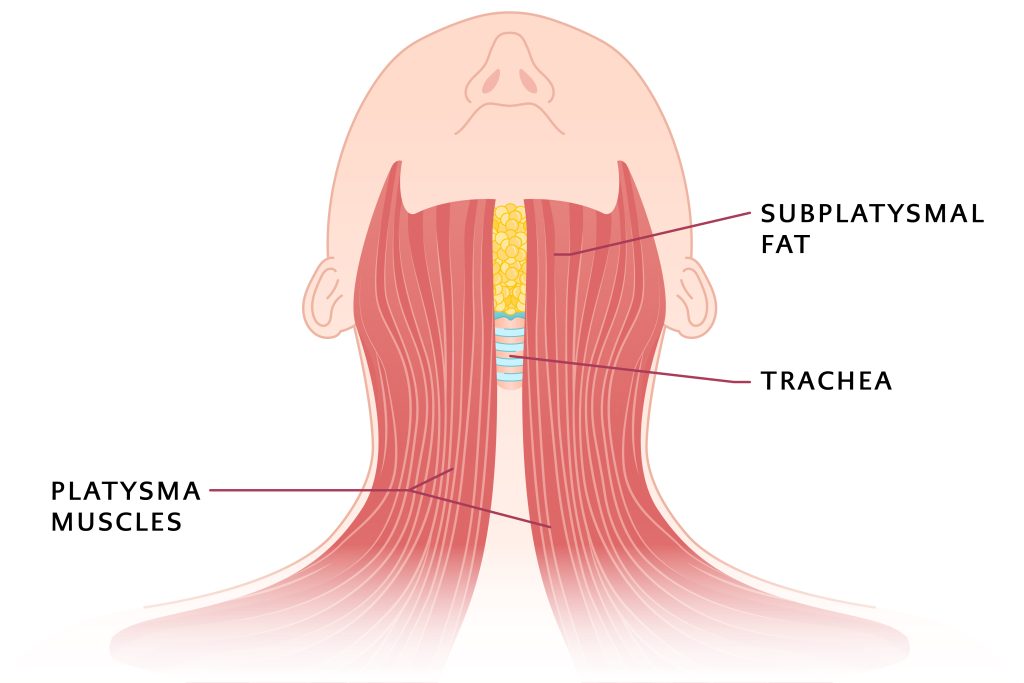 Graphic demonstrating incision for minimal incision neck list