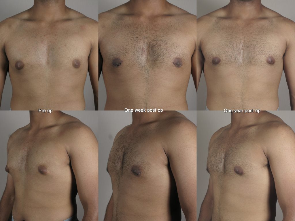 Set of images showing gynecomastia patient, pre-op, one week post op and one year post op showing results