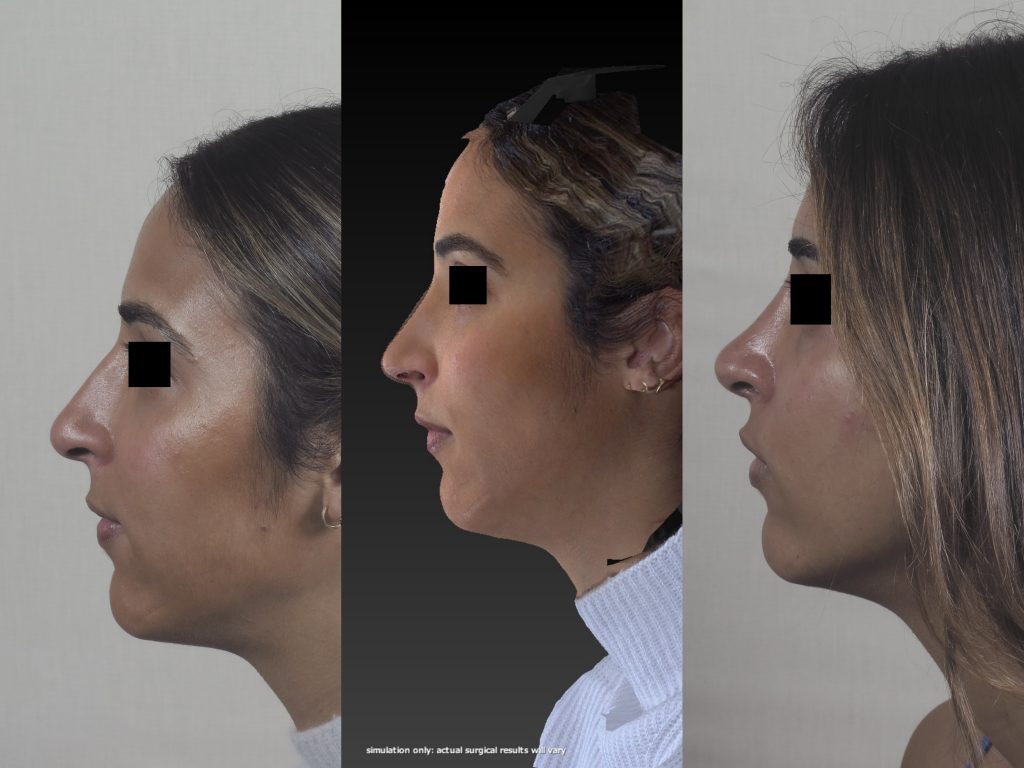 3 images showing pre-op rhinoplasty, the virtual post-op image from Vectra and the actual rhinoplasty post-op.