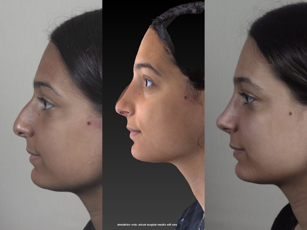 3 columns of images showing a patient pre-op rhinoplasty, the second images shows the Vectra virtual image and the third shows the actual post-op rhinoplasty results.