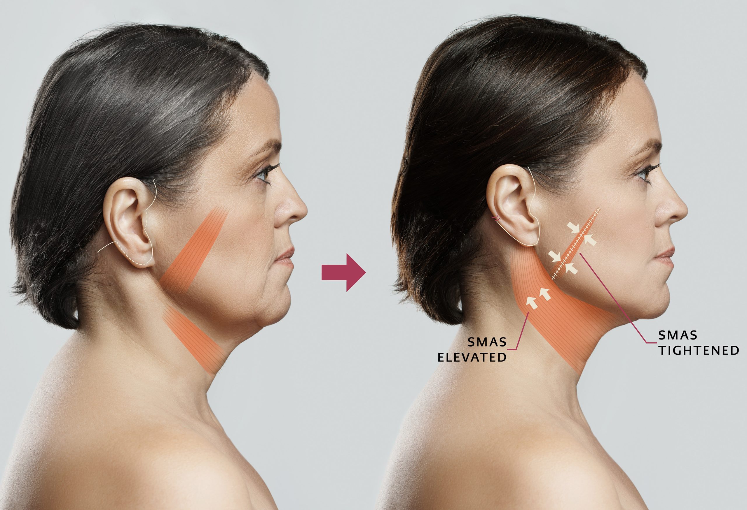 Graphic depicting SMAS tightening and elevating the face and neck area